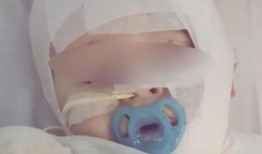男婴在第三次手术前因走咖啡烧伤，“造成混乱”