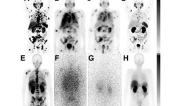 发现低剂量前列腺癌治疗在提高耐受性的同时保持疗效